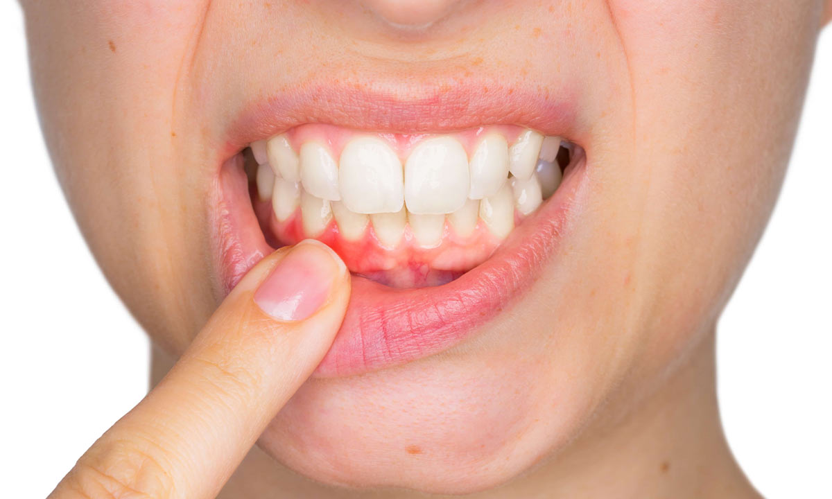 زردی دندان و تورم لثه در عفونت دندان
