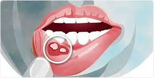آفت دهان یکی از مشکلات رایج در بین افراد جامعه است.