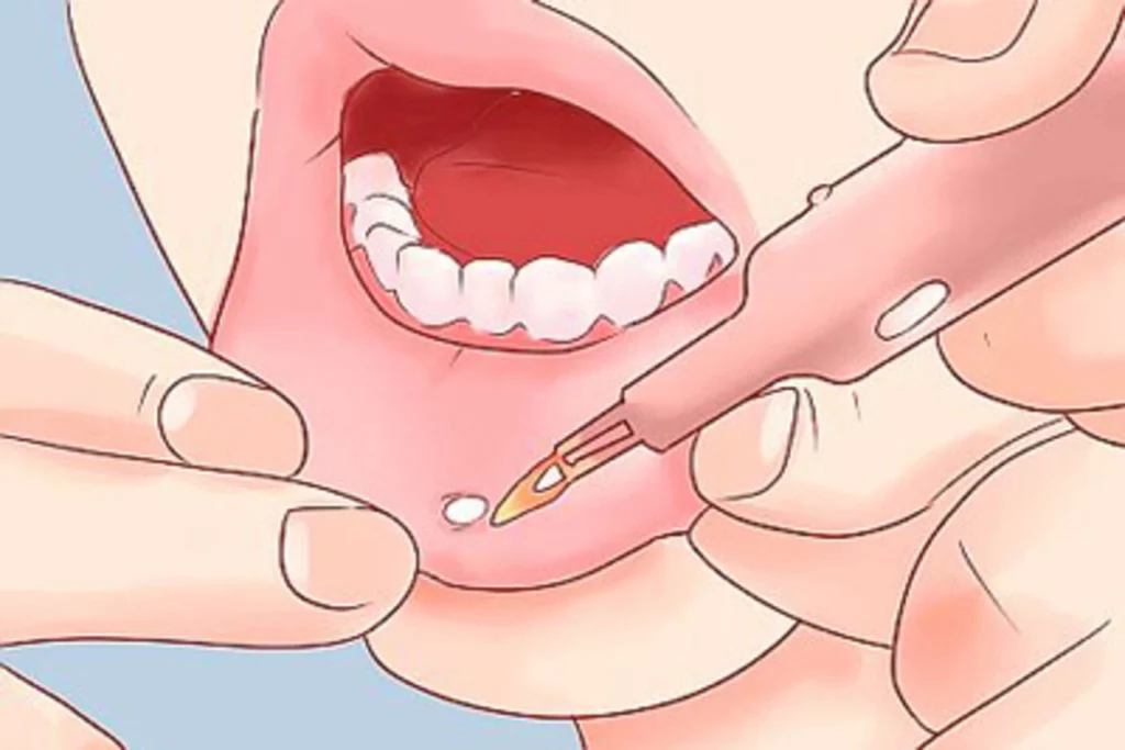 درمان پزشکی آفت دهان