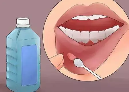 درمان خانگی آفت دهان با دهانشویه یا محلول های نمکی