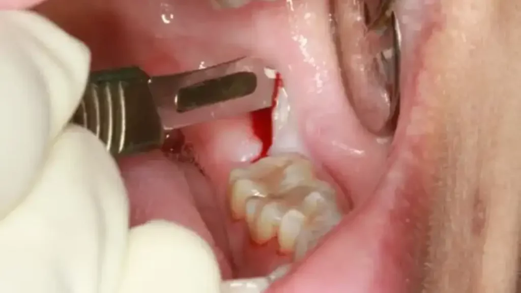 کشیدن دندان به روش جراحی