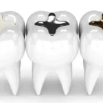 پر کردن دندان با انواع مواد دندانپزشکی