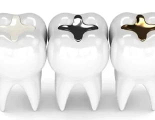 پر کردن دندان با انواع مواد دندانپزشکی