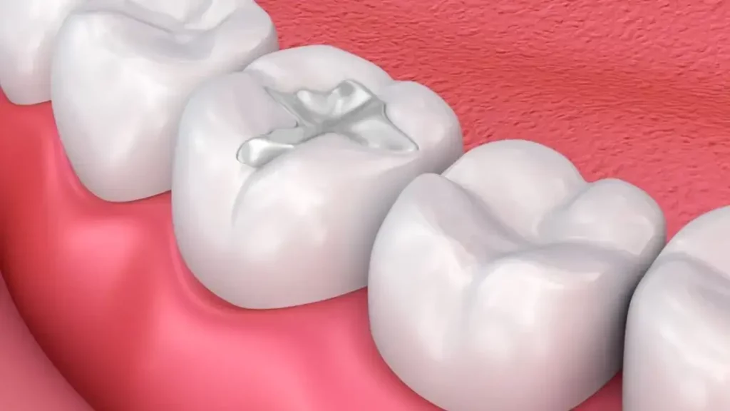 پر کردن دندان با مواد کامپوزیتی
