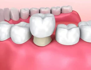 روکش دندان