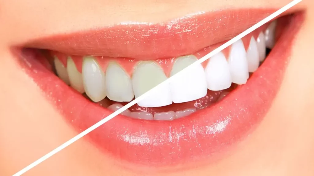بلیچینگ دندان برای سفید کردن دندان ها