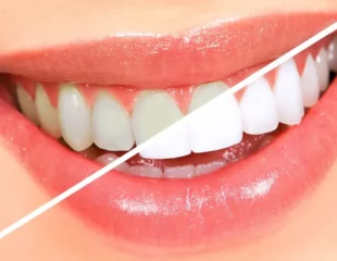 بلیچینگ دندان برای سفید کردن دندان ها