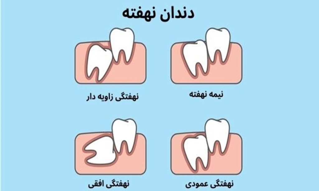 تصویر کارتونی انواع مختلف دندان های نهفته