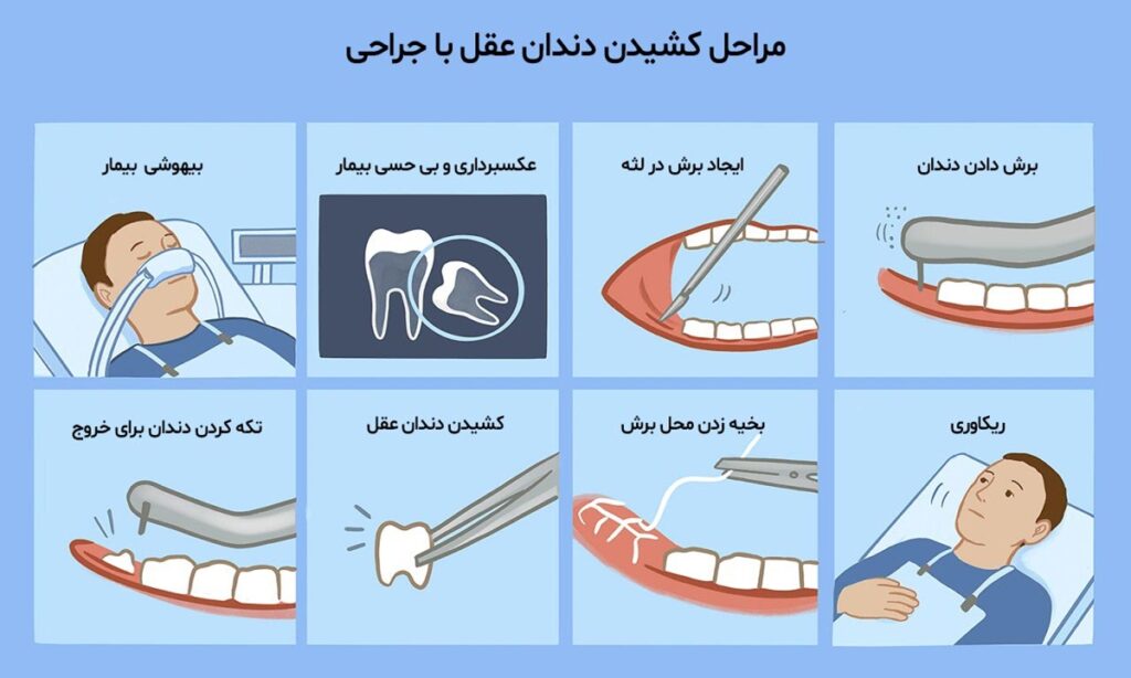  مراحل کشیدن دندان عقل