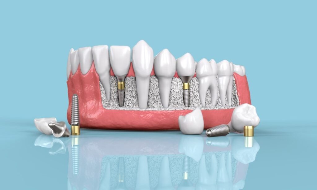 تصویری نشان دهنده ایمپلنت دندان و اجزای آن